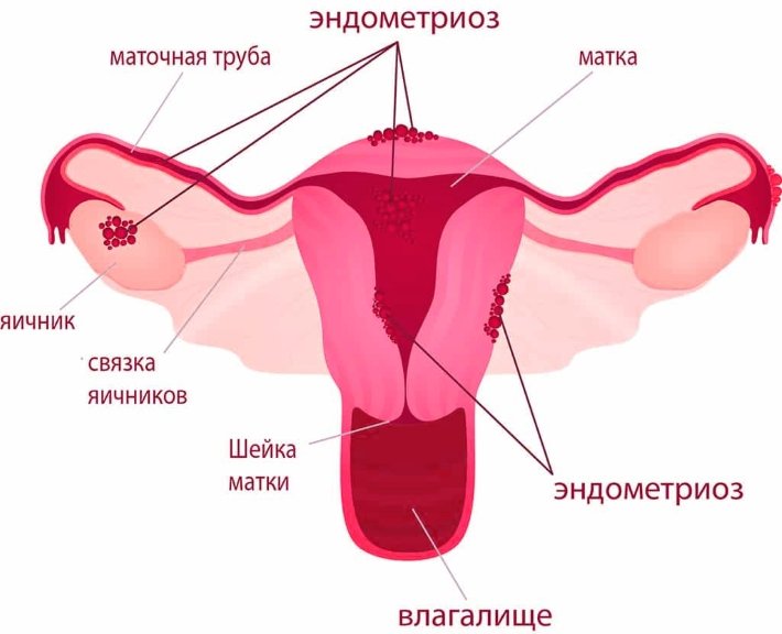 Очаги эндометриоза в теле матки Очаги эндометриоза в теле матки