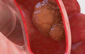 Bowel cancer treatment in Israel Bowel cancer treatment in Israel